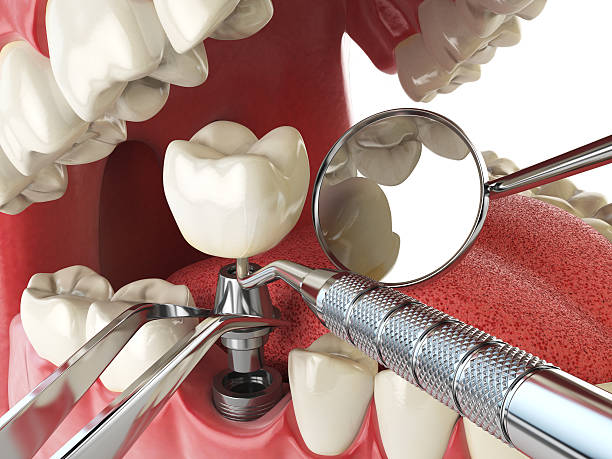Best Broken or Chipped Tooth Repair in Central City, KY